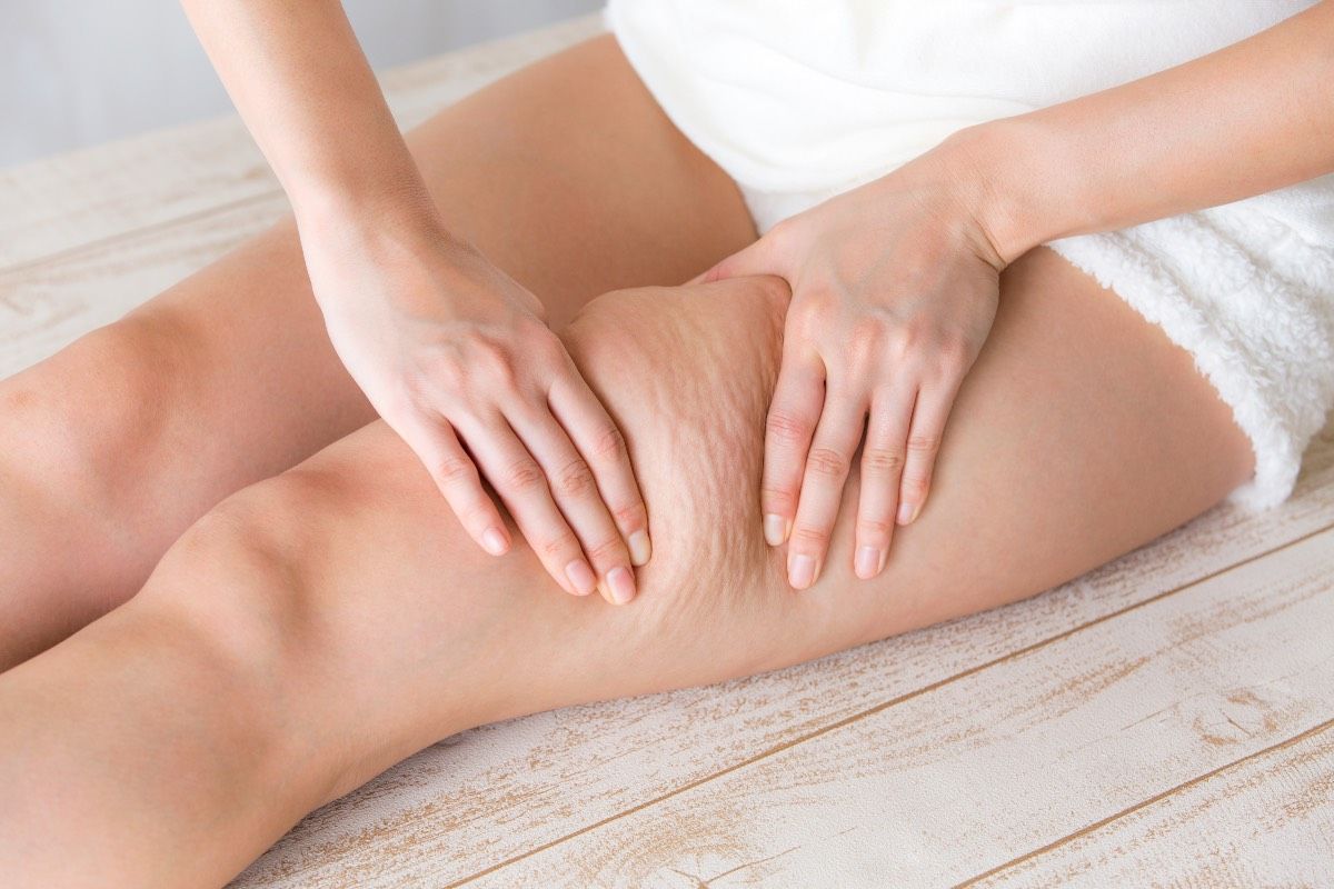 femme qui a de la cellulite sur les cuisses