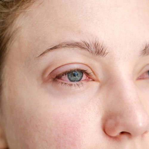 Femme aux yeux rougis par une allergie aux yeux